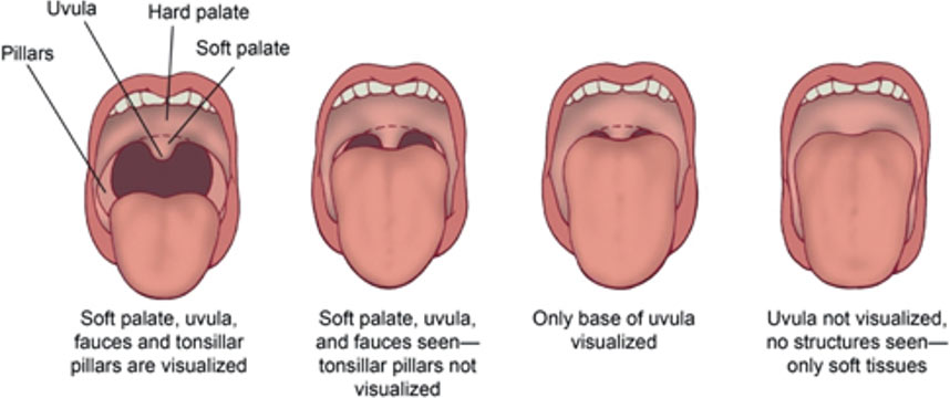 Illustrated mouths showing states of uvula