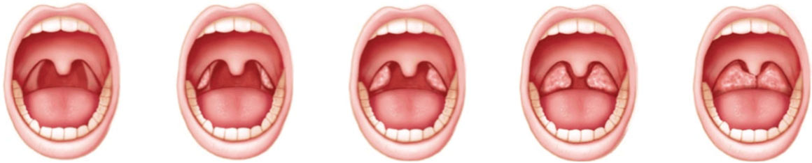 Illustrated mouths showing states of tonsils